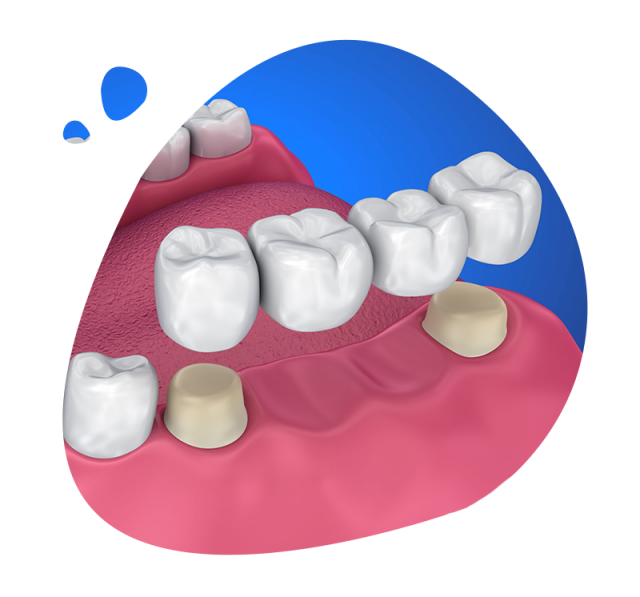 https://www.expertsdentalclinic.com/wp-content/uploads/2021/05/dis-koprusu-640x597.png