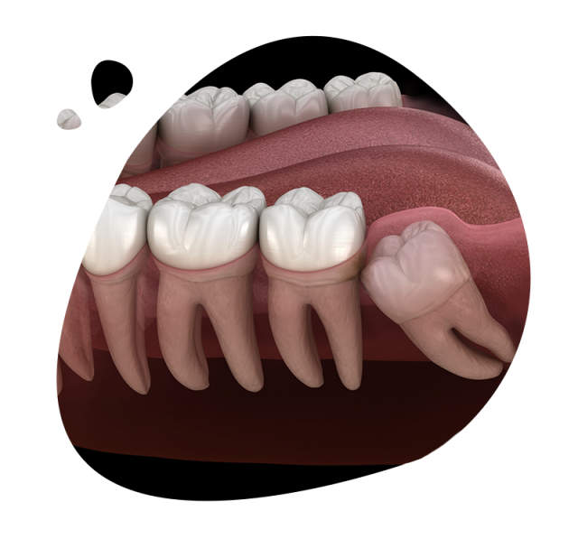 https://www.expertsdentalclinic.com/wp-content/uploads/2021/05/gomulu-dis-ameliyati-640x597.png