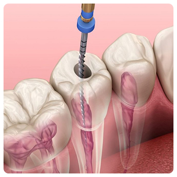 https://www.expertsdentalclinic.com/wp-content/uploads/2021/05/kanal-tedavisi2.jpg